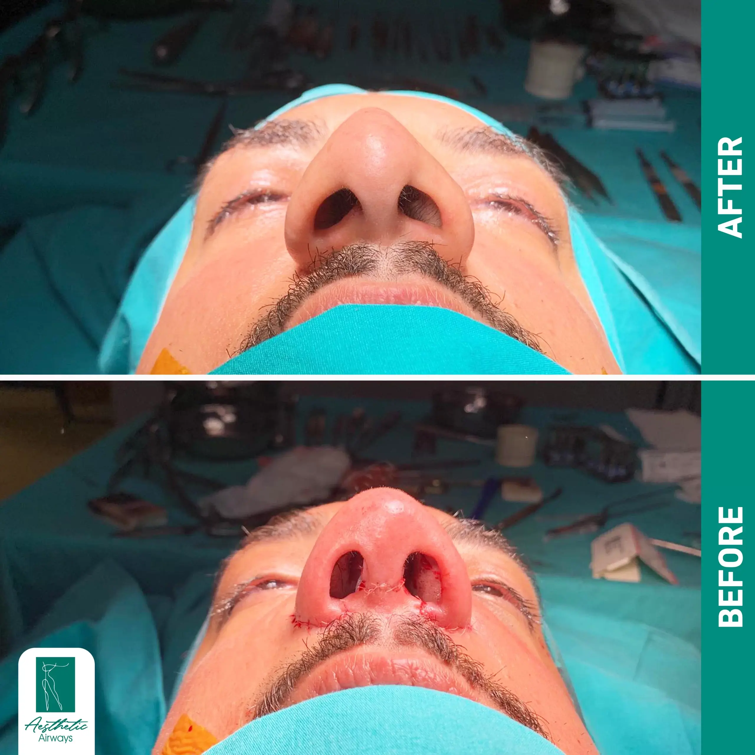 Nose surgery