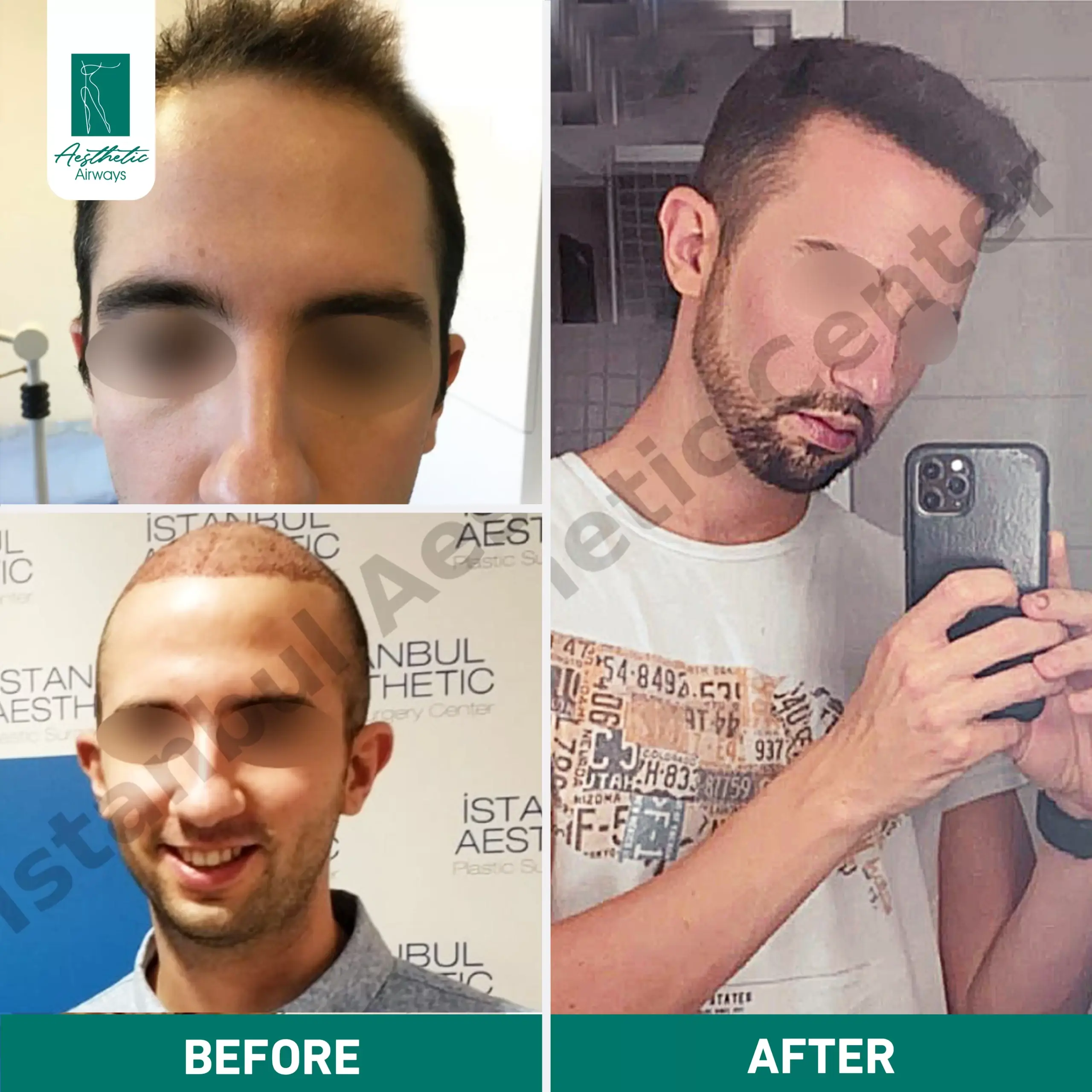 Hair Transplant