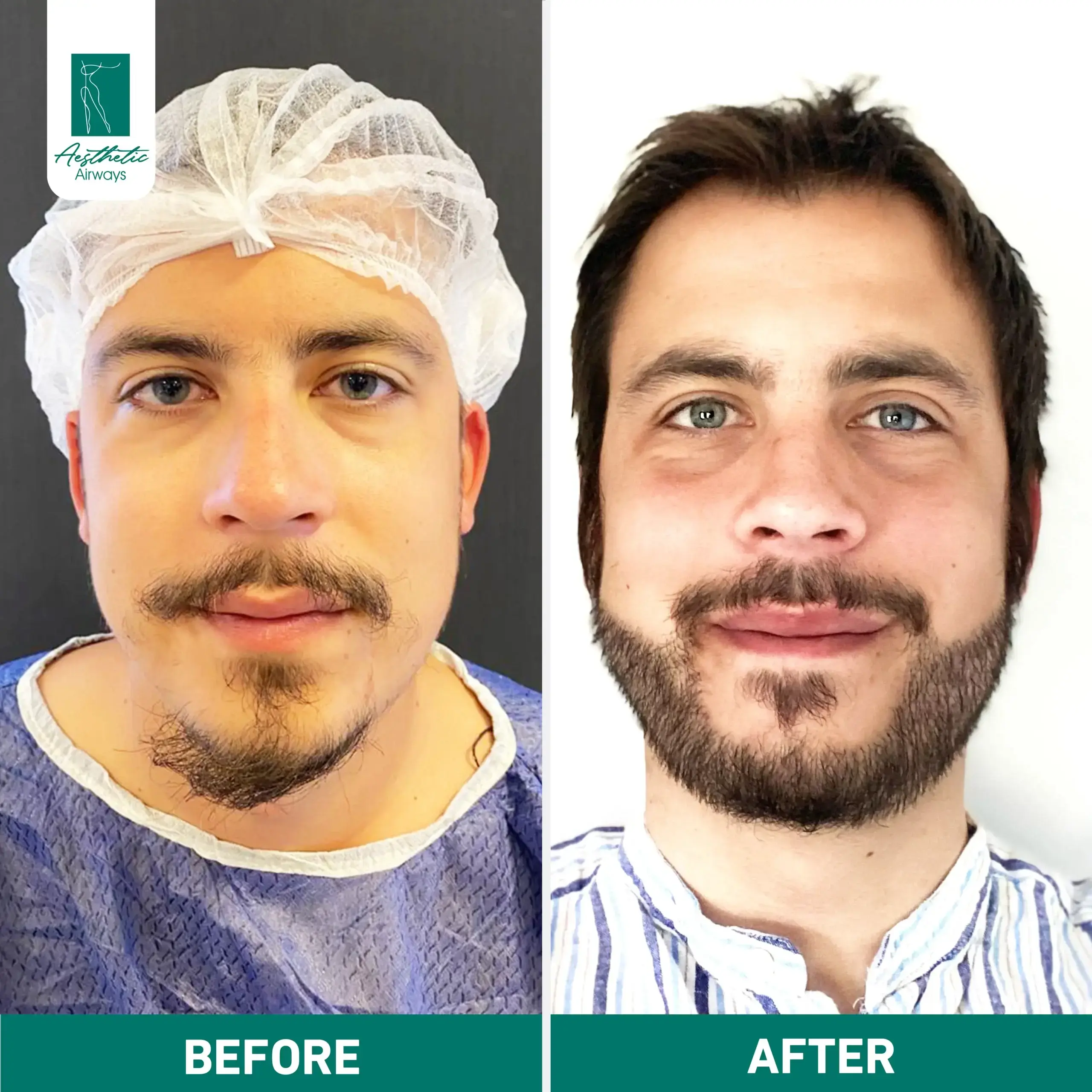 Hair Transplant