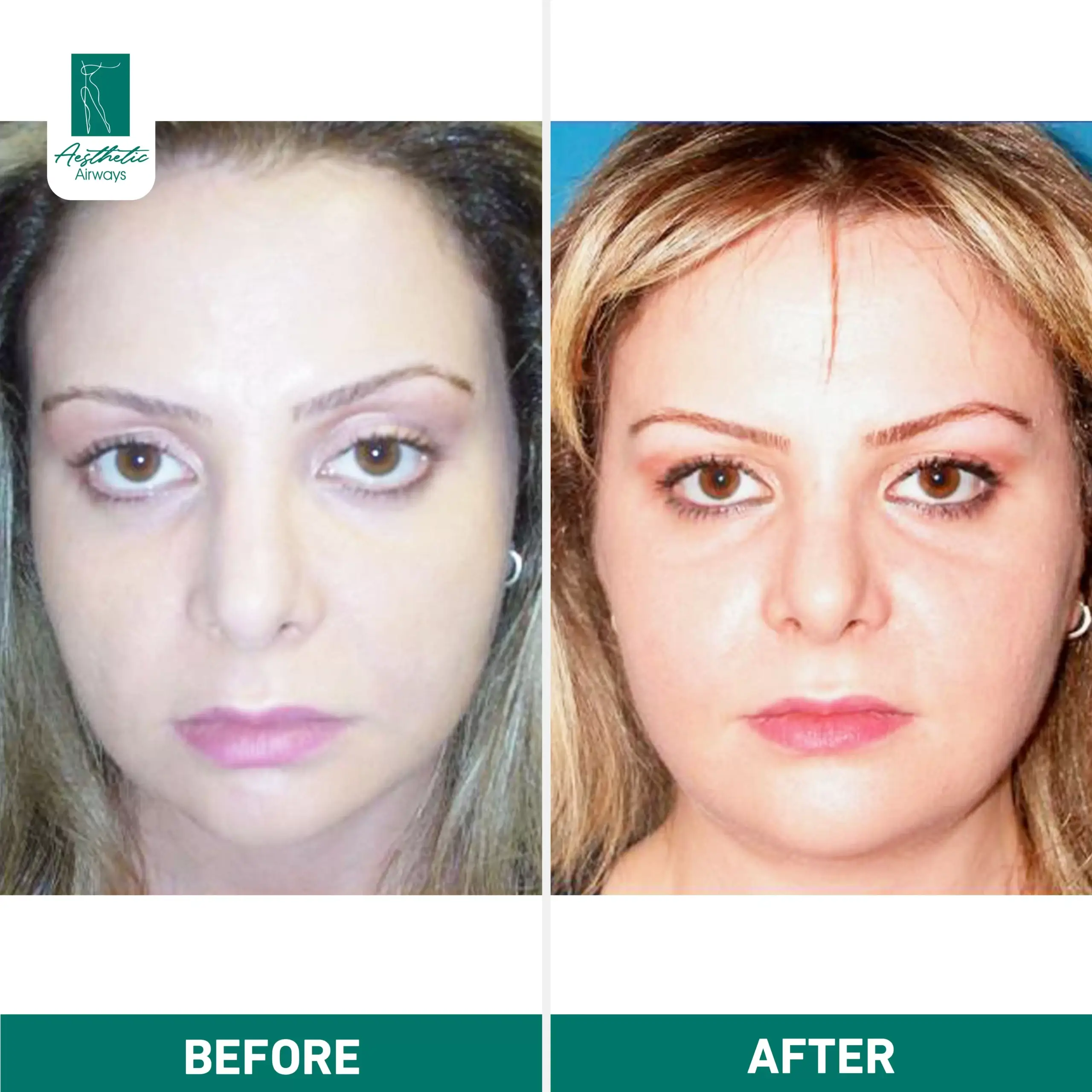 Face Surgery