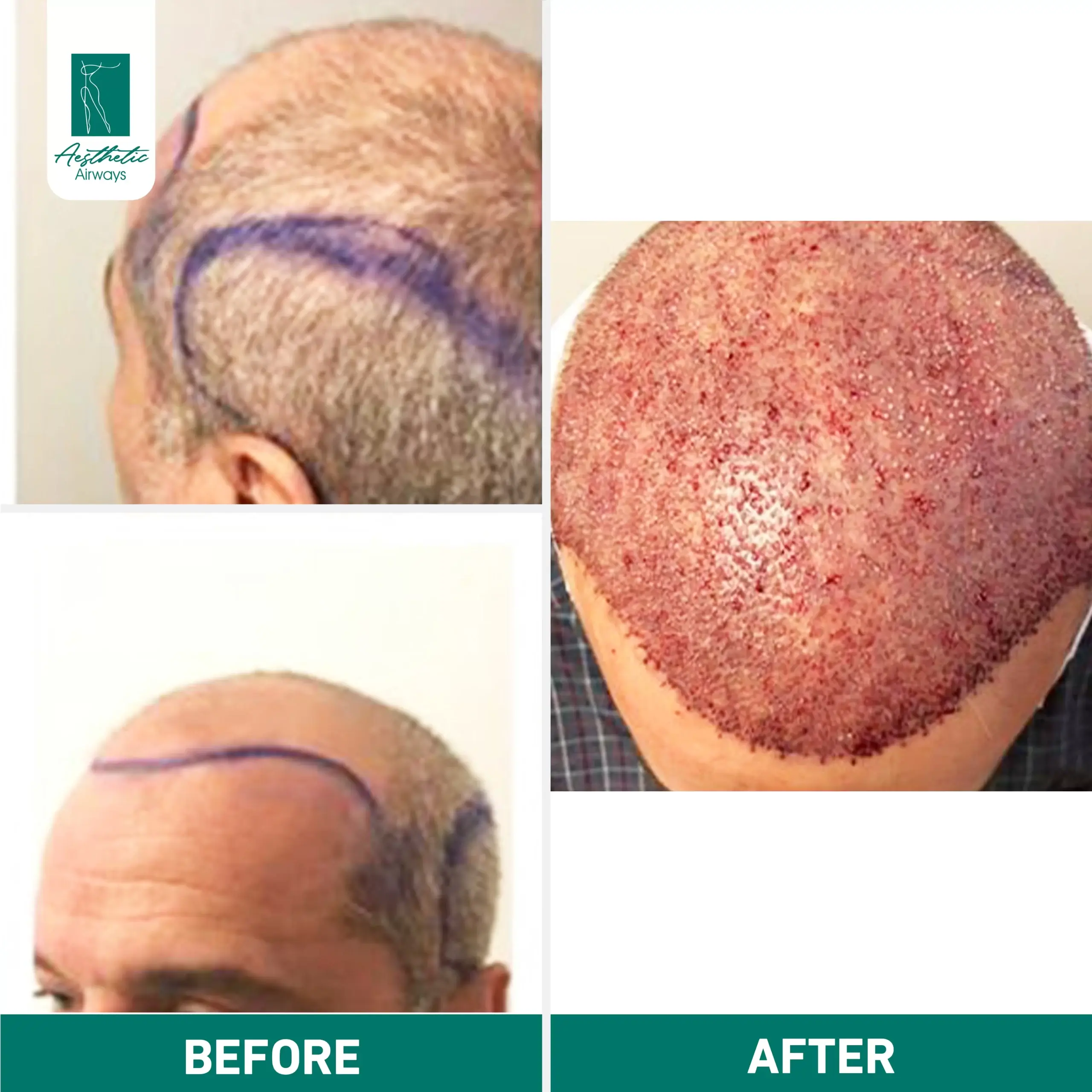Hair Transplant