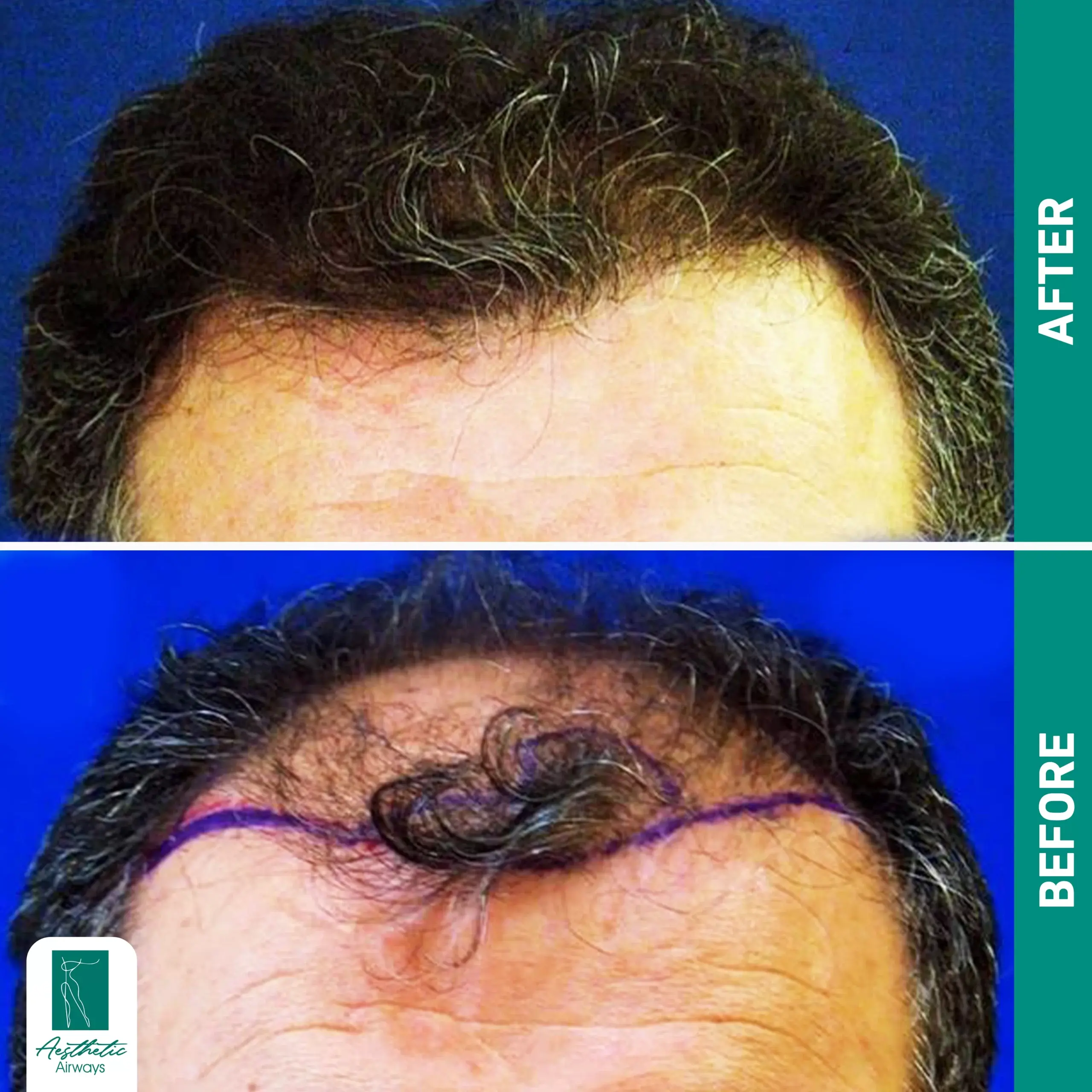 Hair Transplant