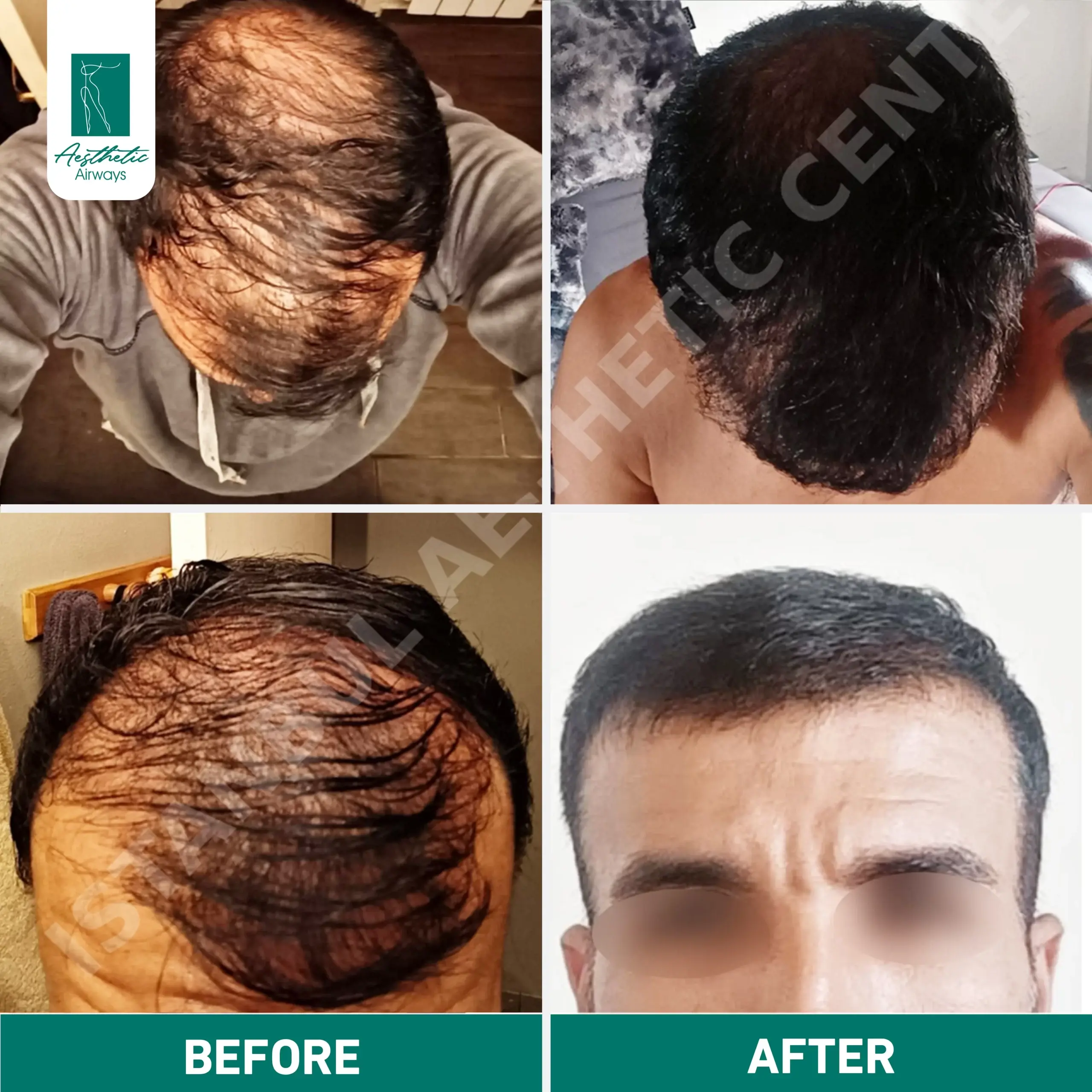 Hair Transplant