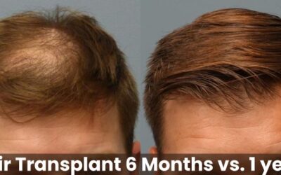 Hair Transplant 6 Months vs. 1 Year: What to Expect During the Recovery Timeline