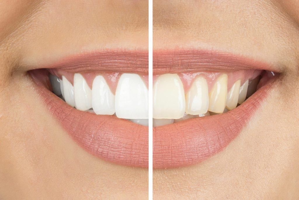 Teeth Whitening Cost Teeth Whitening Cost