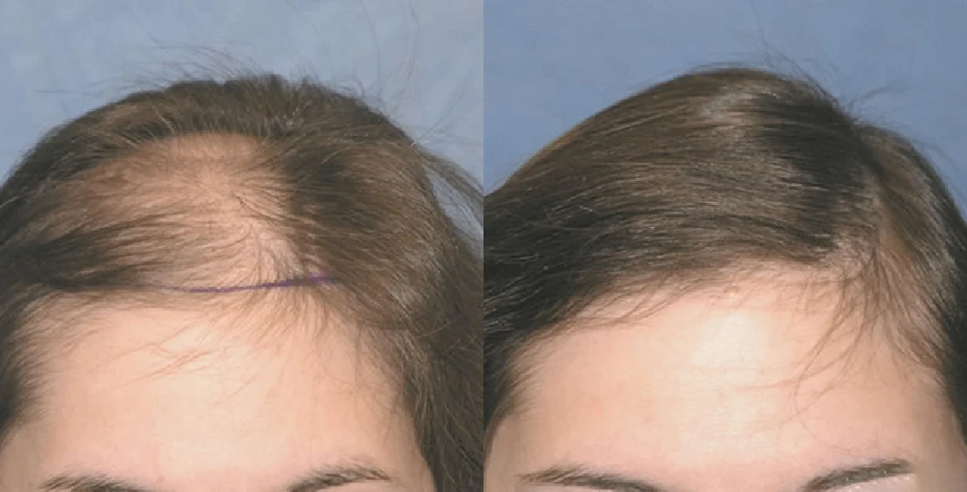 How to Find the Best Hair Transplant in Turkey: Your 2026 Guide to a Full Head of Hair