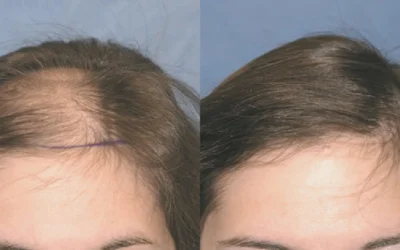 How to Find the Best Hair Transplant in Turkey: Your 2026 Guide to a Full Head of Hair