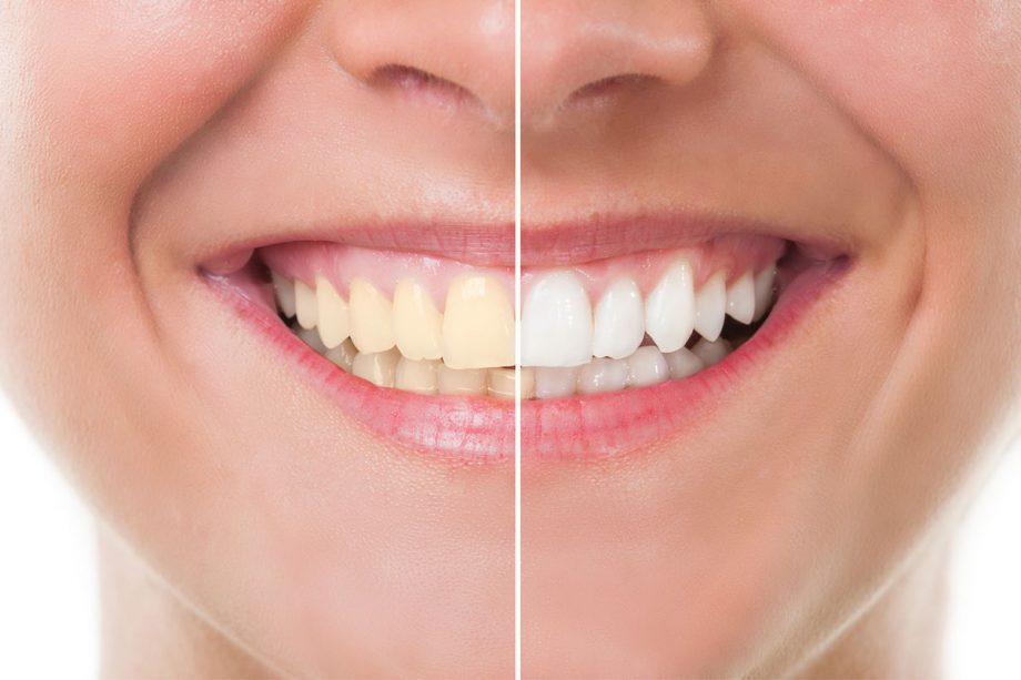 How Much Does Teeth Whitening Cost at the Dentist