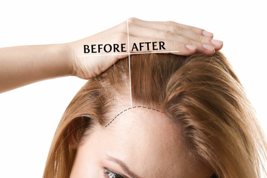 Modern Hair Transplant