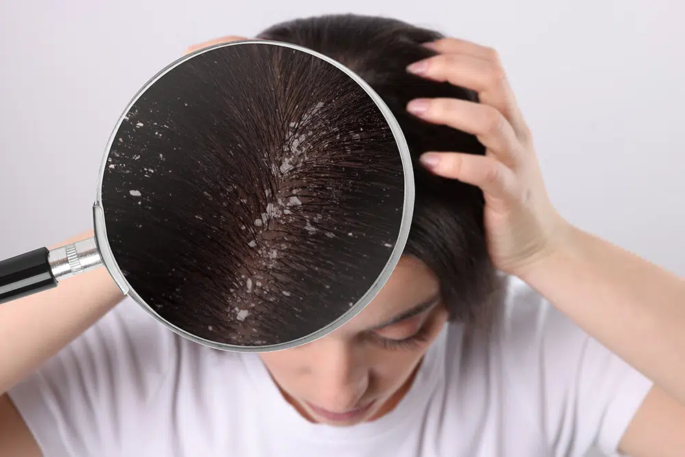 Does Dandruff Shampoo Cause Hair Loss