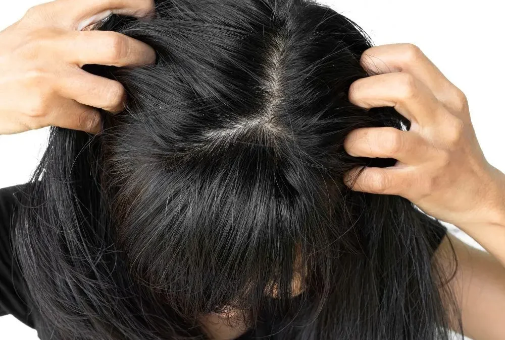 Does Dandruff Cause Hair Loss? The Flaky Truth About Scalp Health & Thinning