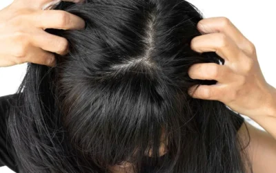 Does Dandruff Cause Hair Loss? The Flaky Truth About Scalp Health & Thinning