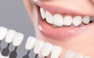 Emax Veneers vs. Porcelain Veneers: Which is Best for Your Smile?