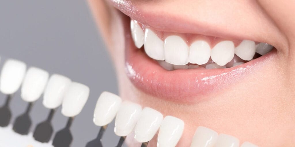 Emax Veneers vs. Porcelain Veneers