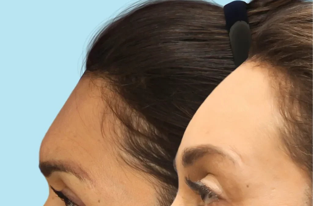 Considering Your Options: Forehead Reduction vs. Hair Transplant