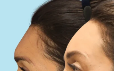 Considering Your Options: Forehead Reduction vs. Hair Transplant