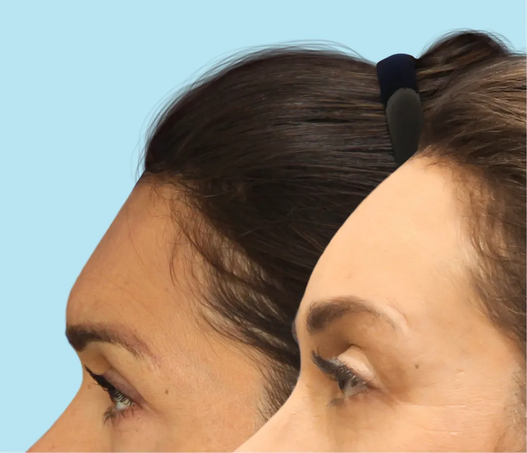 Forehead Reduction vs. Hair Transplant