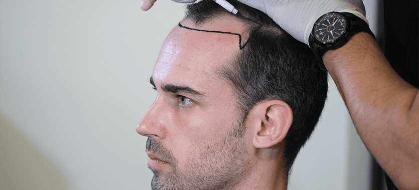 Hair Plugs vs. Hair Transplants: What is the Real Difference in 2026?