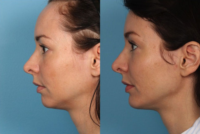 Forehead Reduction Before and After