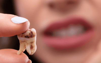 how can we prevent tooth decay: Your Ultimate Guide to a Cavity-Free Smile