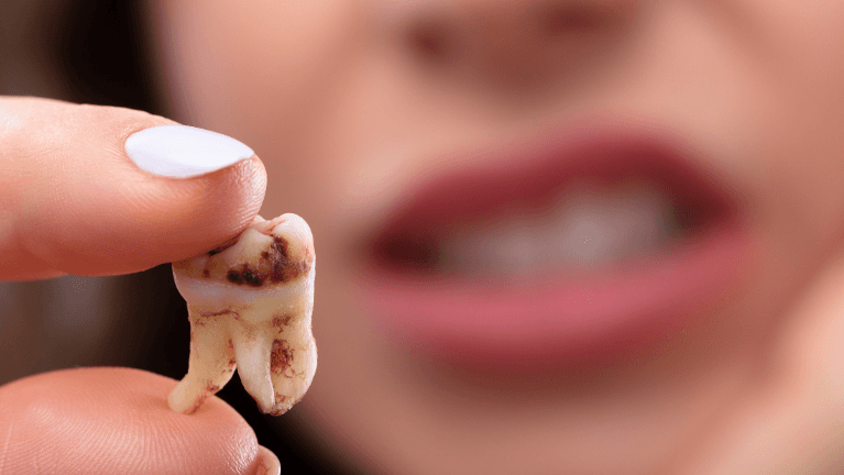 how can we prevent tooth decay