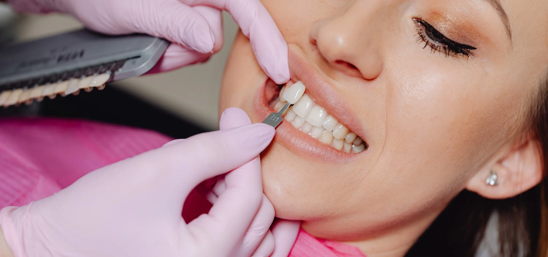 Emax Porcelain Veneers